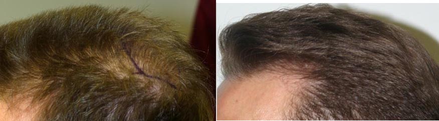 patient-8-diagnosis-crown-hair-loss