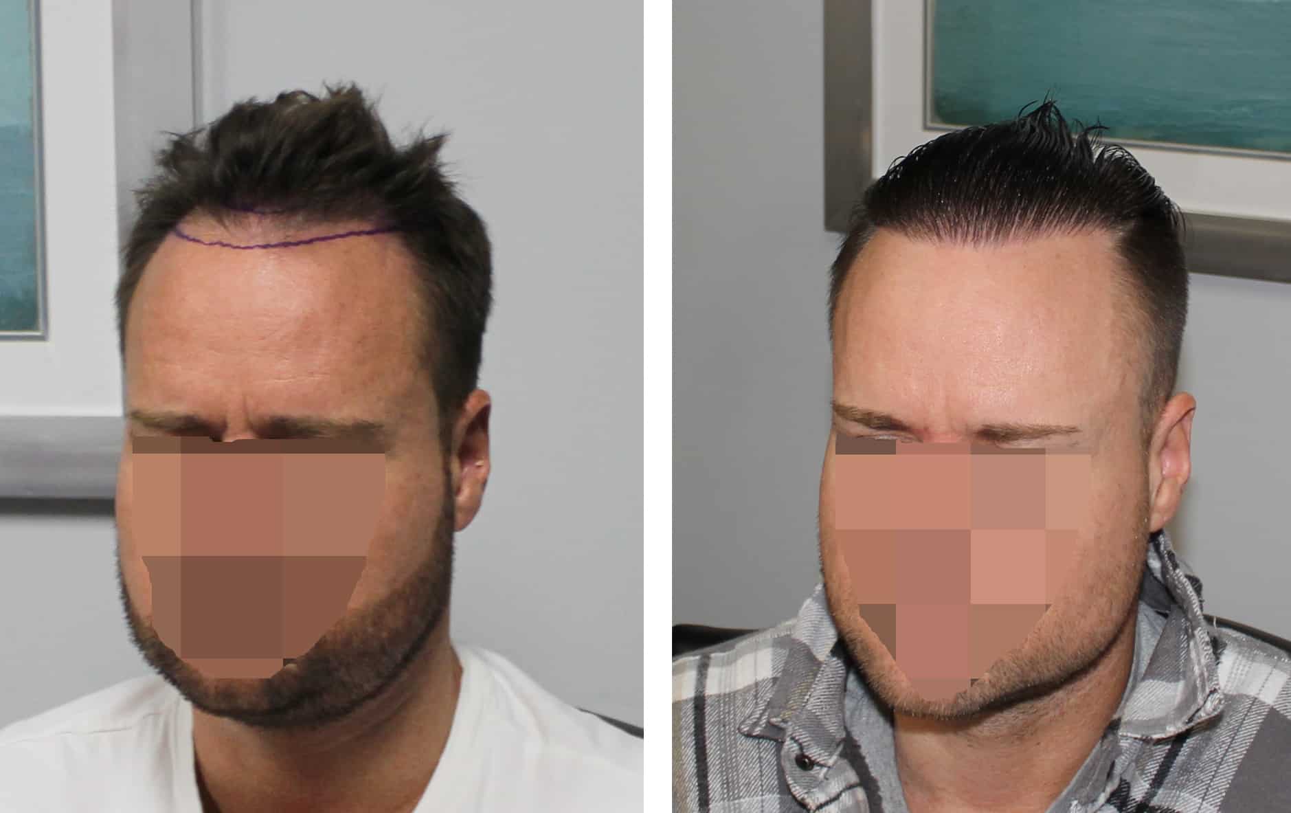 patient-20-2-000-graft-hairline-hair-transplant