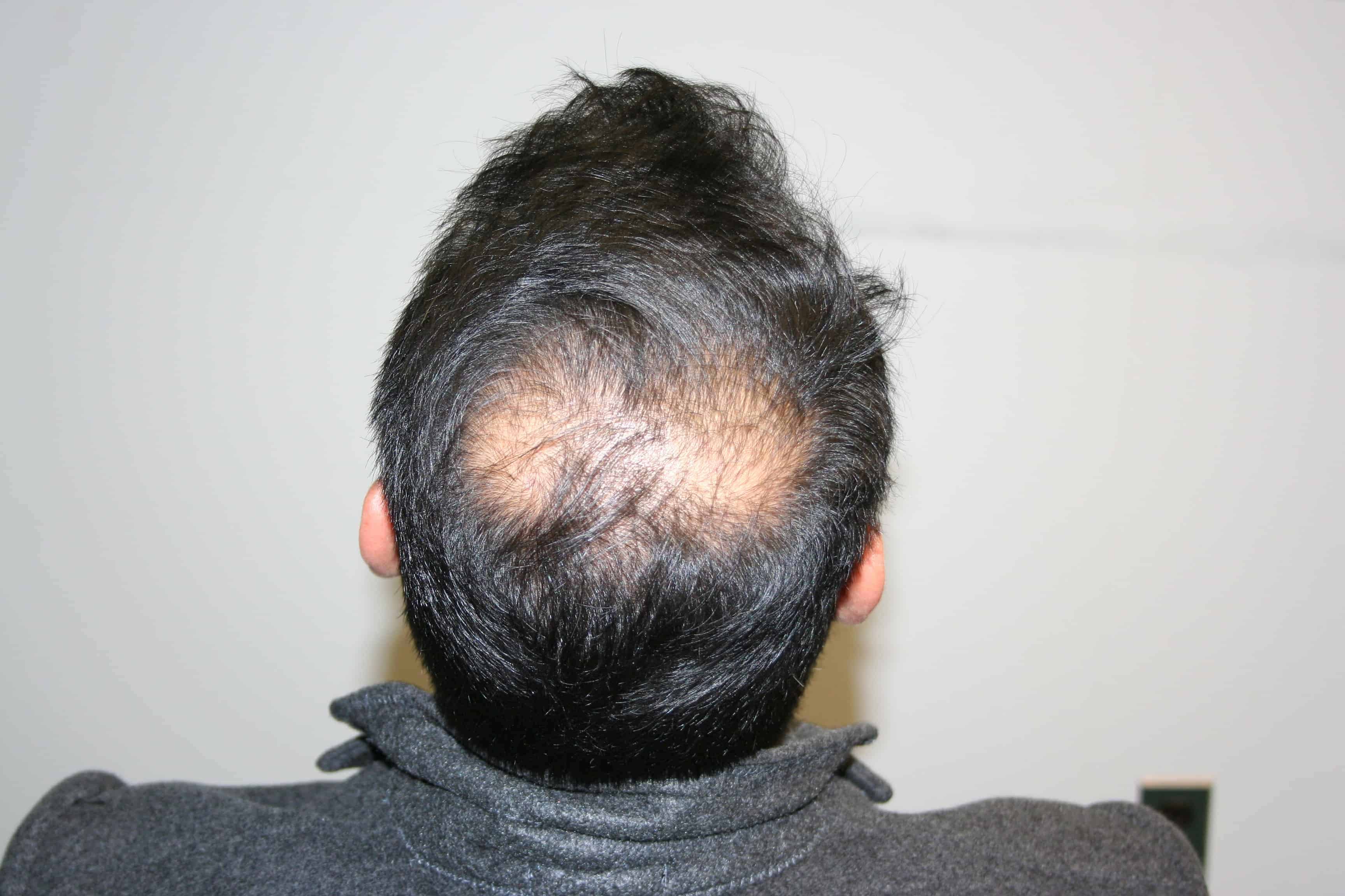 Male Hair Loss Causes - FELLER & BLOXHAM MEDICAL