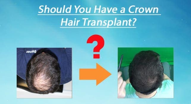 Crown Hair Transplant - Feller & Bloxham Medical