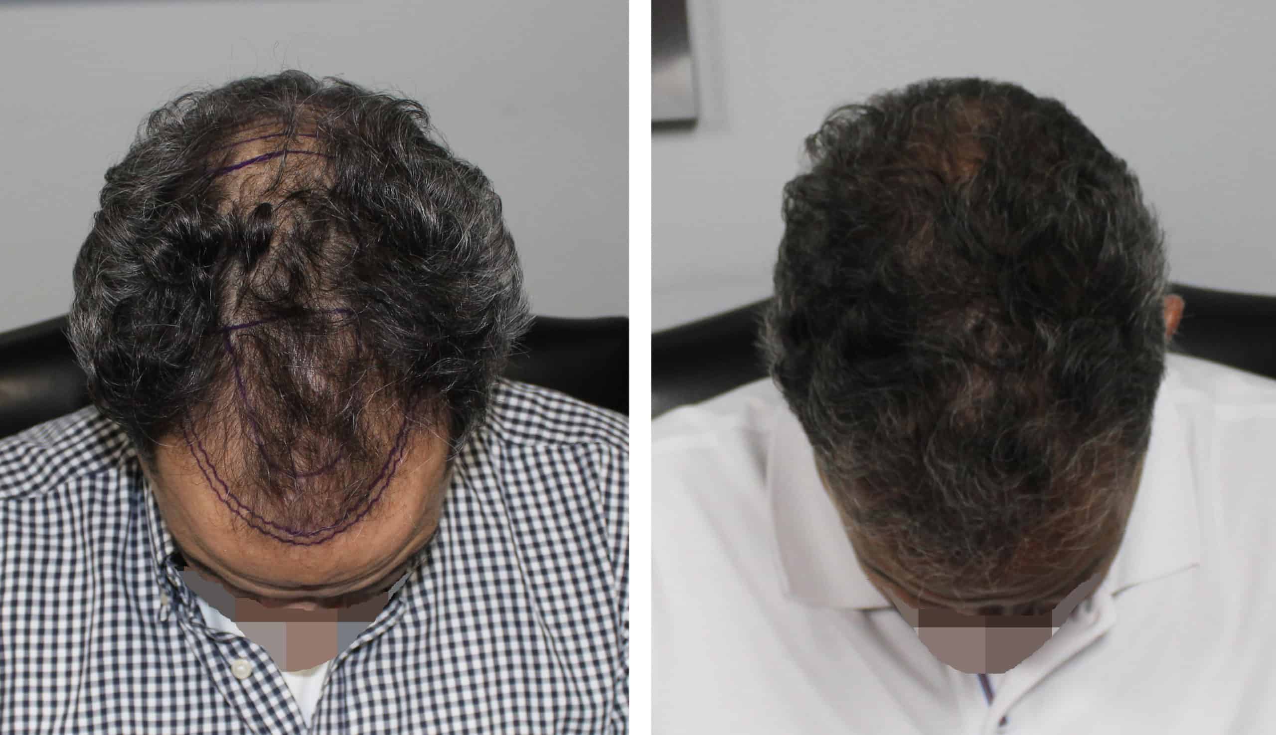 Why Don T We Do 5 000 Grafts Wouldn T More Grafts Make A Better Hair Transplant Result