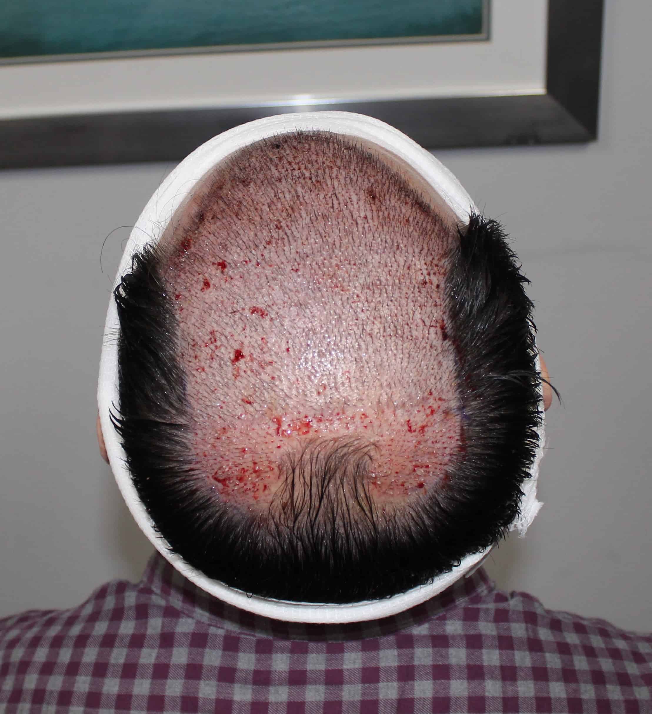 Why don't we do 5,000 Grafts? Wouldn't more Grafts Make a Better Hair  Transplant Result?