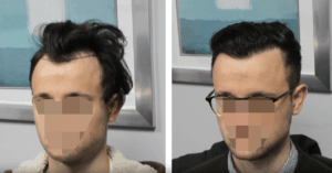 Before & After Hair Transplant Image 2 - Feller & Bloxham Medical