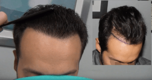 Before & After Hair Transplant Image 1 - Feller & Bloxham Medical