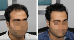 Before & After Hair Transplant - Feller & Bloxham Medical