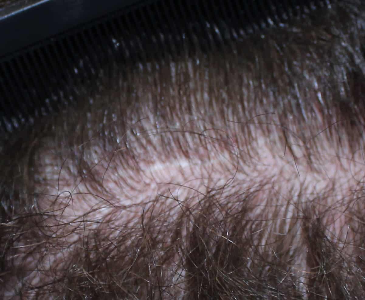 Does a Hair Transplant Leave a Scar? | Feller & Bloxham Medical