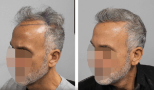 Hair Transplant with Gray Hair - Feller & Bloxham Medical