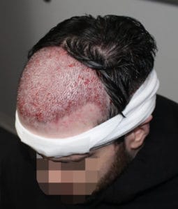 Patient Immediately After Hair Transplant Surgery