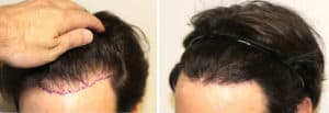 Patient 72 Hair Photos 3- FELLER & BLOXHAM MEDICAL