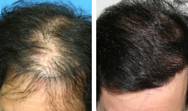 Patient 76 Hair Photos- FELLER & BLOXHAM MEDICAL
