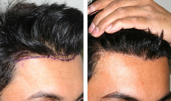 Patient 77 Hair Photos- FELLER & BLOXHAM MEDICAL