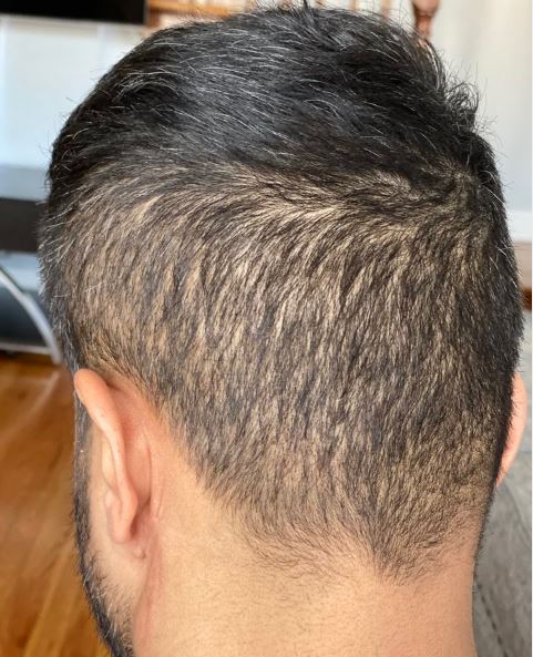Can I Have an FUT (“Strip”) Surgery AFTER an FUE Surgery?