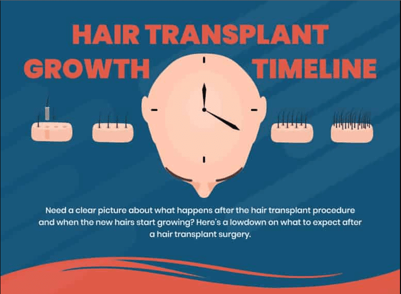 How long does the shedding phase last after a hair transplant? - Quora