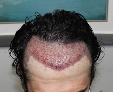 Article – What to Expect After a Hair Transplant