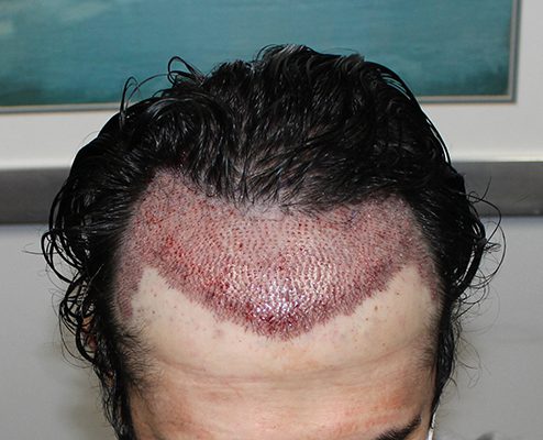Percutaneous Hair Transplant - Evaesthetic