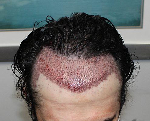 FUE Shock Loss After Hair Transplants  Northwestern Specialists