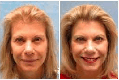 Hair Restoration for Women New York