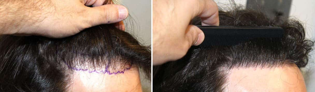 Patient 72 Hair Photos 1- FELLER & BLOXHAM MEDICAL