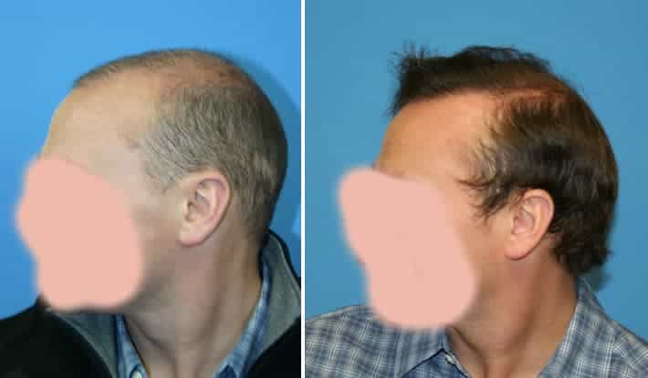 Patient 74 Hair Photos 2- FELLER & BLOXHAM MEDICAL