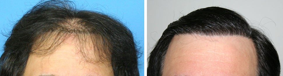 Patient 76 Hair Photos 1- FELLER & BLOXHAM MEDICAL
