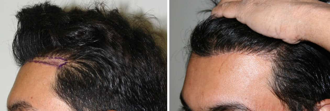 Patient 77 Hair Photos 3- FELLER & BLOXHAM MEDICAL