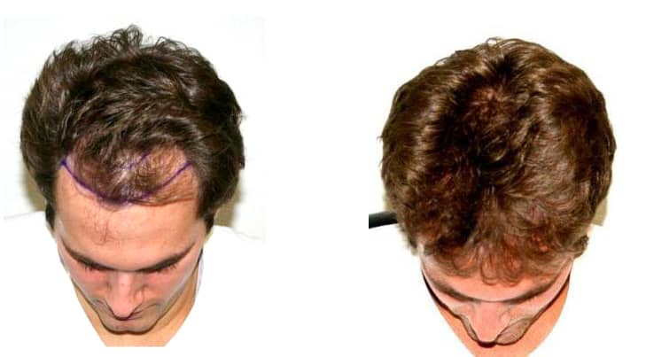 Patient 78 Hair Photos 3- FELLER & BLOXHAM MEDICAL