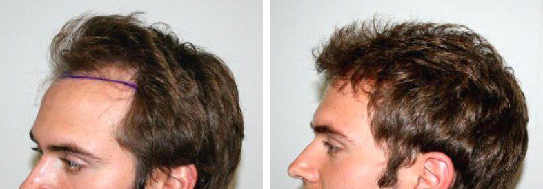Patient 78 Hair Photos 2- FELLER & BLOXHAM MEDICAL