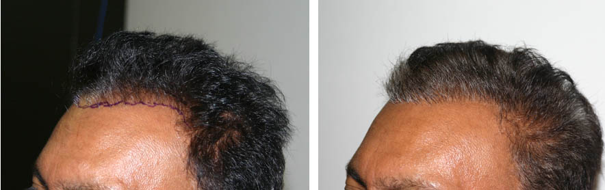 Patient 79 Hair Photos 1- FELLER & BLOXHAM MEDICAL