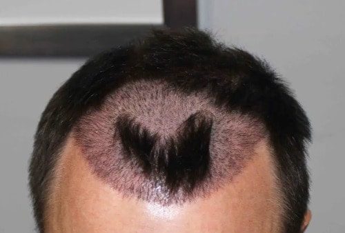 Growth of Hair After FUE  Maral Hair