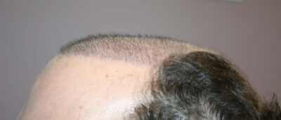 Experienced Hair Transplant Clinic in New York