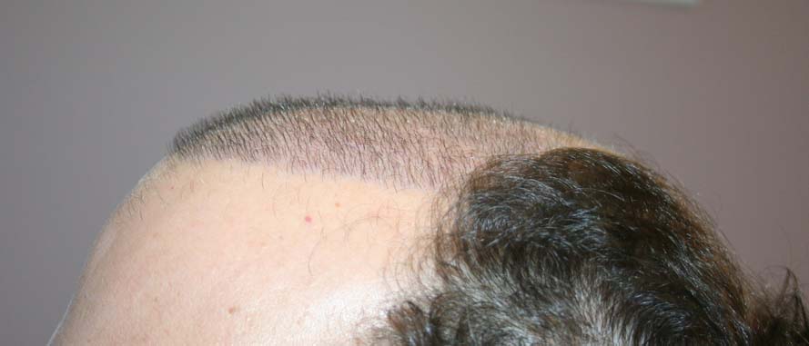 Experienced Hair Transplant Clinic in New York