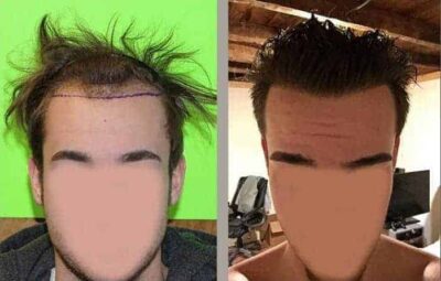 Low Hairline with Hair Transplant Surgery