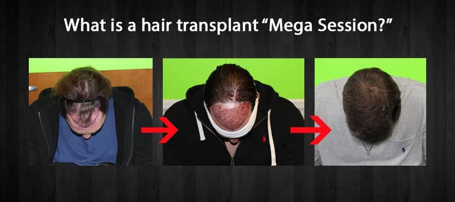 Hair Transplant Mega Session