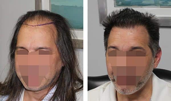 Patient 22 Hair Photos- FELLER & BLOXHAM MEDICAL