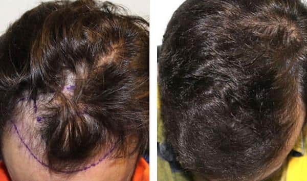 Patient 24 Hair Photos- FELLER & BLOXHAM MEDICAL