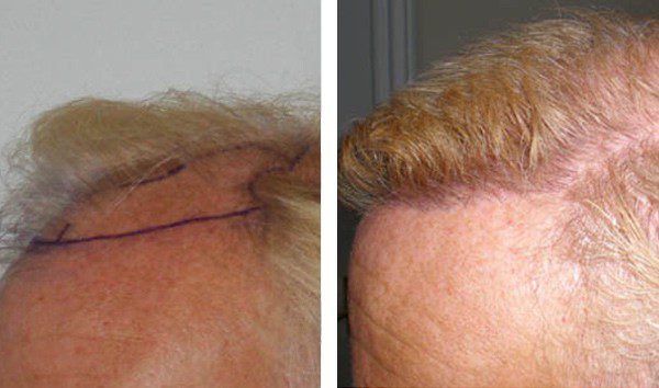 1. Hair Transplant for Fine Blonde Hair - wide 3