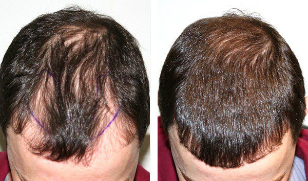 A Guide to High Density Hair Transplantation - Hair Transplant Specialists  - Treatment Rooms London