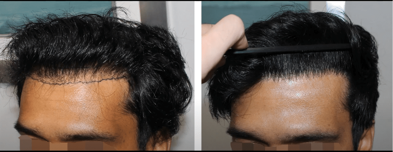 High density vs low density - Hair Transplant