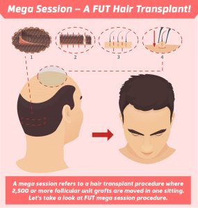 Mega Session – A FUT Hair Transplant!