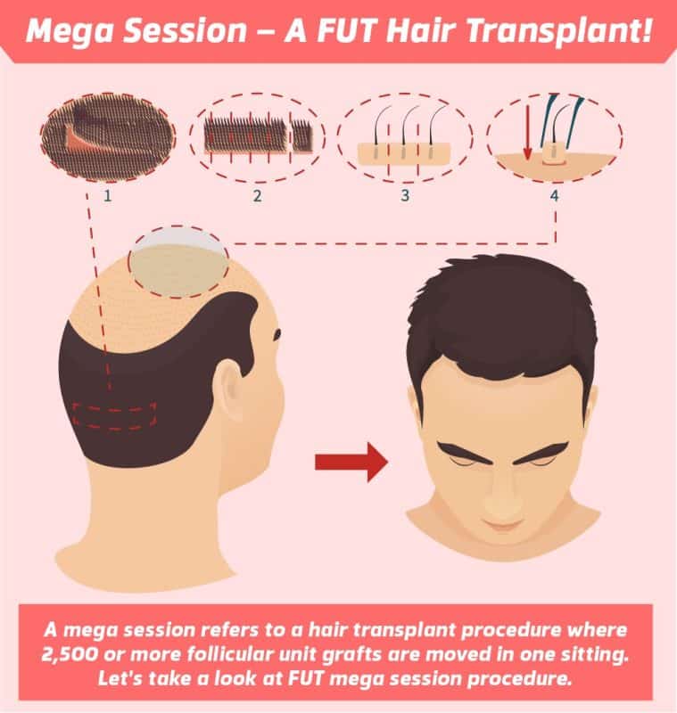 Mega Session - A FUT Hair Transplant