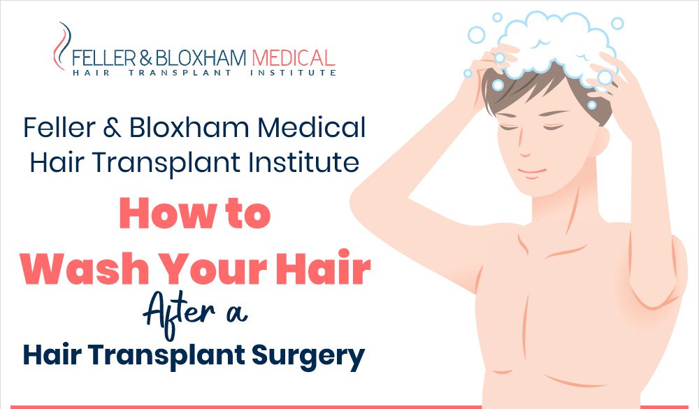 Feller & Bloxham Medical Hair Transplant Institute – How to Wash Your Hair After a Hair Transplant Surgery