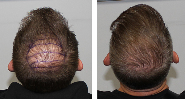 Hair loss treatment