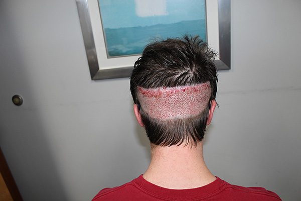 Hair transplant for scalp scars