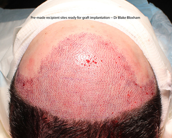 Are big hair transplant sessions aka Mega Sessions safe