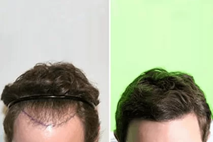 Before/ After Hair Transplant Photos