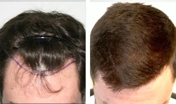 Patient 33 Hair Photos- FELLER & BLOXHAM MEDICAL