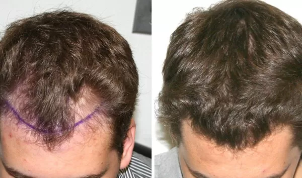 Patient 34 Hair Photos- FELLER & BLOXHAM MEDICAL