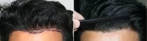 Patient 77 Hair Photos 2- FELLER & BLOXHAM MEDICAL