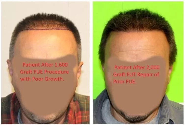 Before & After Fue vs Fut Repair - Feller & Bloxham Medical