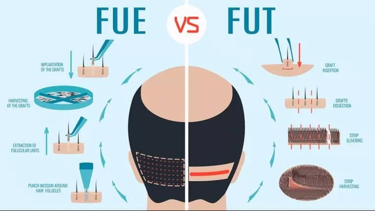 FUE vs. FUT Hair Transplant Surgery? - Feller & Bloxham Medical